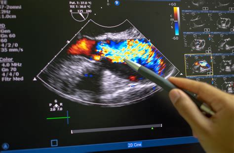 Echocardiography Ultrasound Parker University