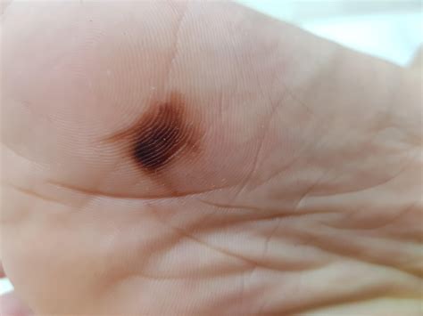 Just Found Out This Under My Foot Is This Melanoma Rmelanoma