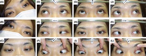 Traumatic Bilateral Fourth Nerve Palsy Double Vision Induced By