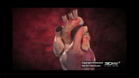 Heart Surgery Prosthetic Aortic Valve Replacement Surgery Youtube