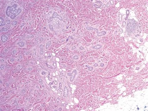 Syringoid Eccrine Carcinoma Mdedge Dermatology