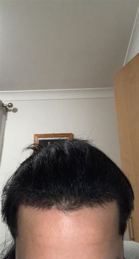 Am I Receding Or Has The Barber Messed Up My Hairline R