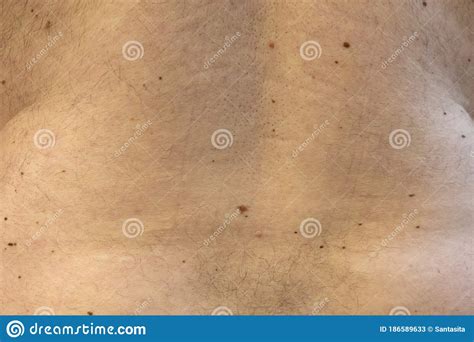 Men`s Back In Moles Doctor`s Examination Photo Stock Image Image Of