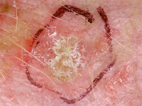 Interesting Facts Is It Skin Cancer 38 Photos That Could Save Your Life