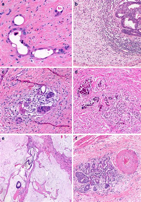 Histologic Findings Of Tumors Treated By Neoadjuvant Radio