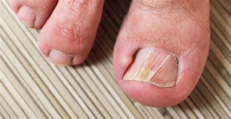 What Causes Split Toenails And Tips To Prevent Them