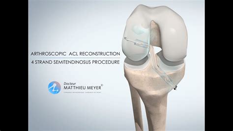 ARTHROSCOPIC ACL RECONSTRUCTION ST4 PROCEDURE DR MATTHIEU MEYER