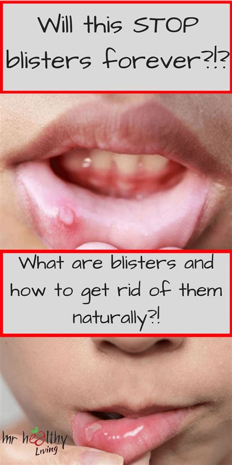 What Are Blisters And How To Get Rid Of Them Naturally Mr Healthy