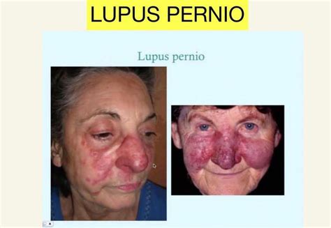 Lupus Pernio Medizzy
