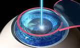 Images of Advances In Lasik Eye Surgery