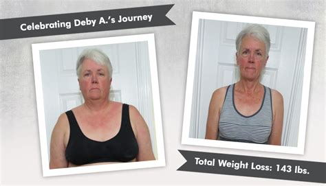 Before And After Rny Gastric Bypass With Deby A Obesityhelp