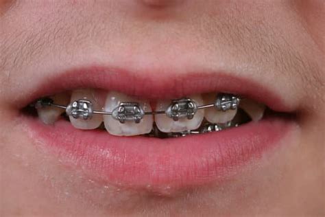 How Do Braces Stay On The Teeth Jacanswers
