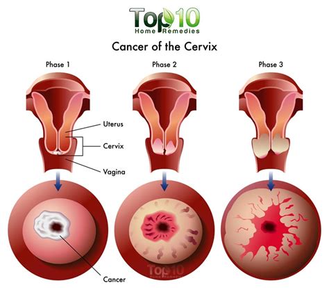 It's a way to figure out how advanced your cancer is and what kind of treatment works best. 10 Warning Signs of Cervical Cancer You Should Not Ignore ...