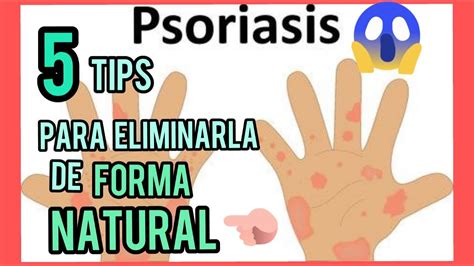 5 Tips Increibles Para Curar La Psoriasis De Forma Natural Youtube