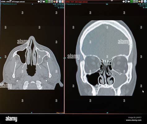 Ct Scan Of Male With Sinus Infection Sinusitis Filling The Left Stock