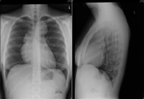 Chest X Ray Pa And Lateral Views Open I