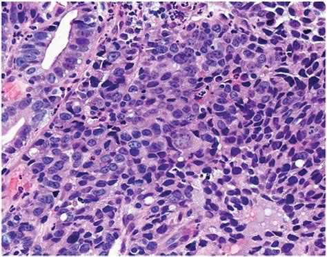 3 Photomicrograph Of The Esophageal Carcinoma Showing Poorly