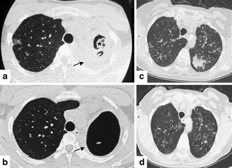 Examples Of Radiological Response In Chronic Pulmonary Aspergillosis