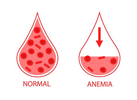 Comparing Two Drops Of Blood Normal And Anemic Blood Cells Low