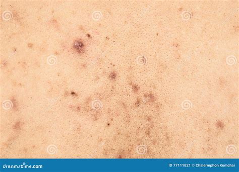 Boy With Problematic Skin And Acne Scars In The Back Stock Image