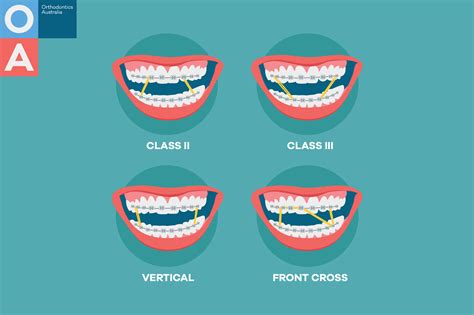 Orthodontics Australia Elastics For Braces Rubber Bands In Orthodontics