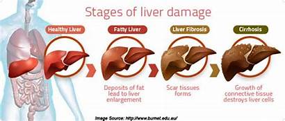 Liver Cancer Types Symptoms Treatment Causes Diagnosis