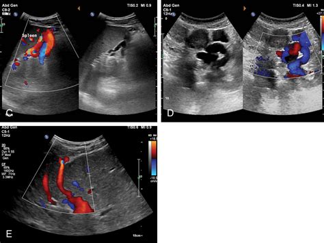 The Role Of Ultrasound In Portal Hypertension Radiology Key