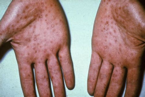 hiv rash vs syphilis rash symptoms causes treatment