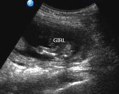 Can Ultrasound Be Wrong About Gender Intensiveover