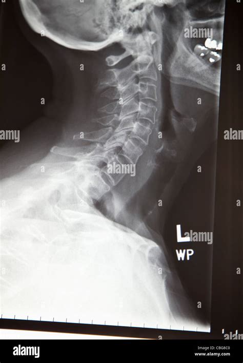 Close up de una radiografía del cuello humano Fotografía de stock Alamy