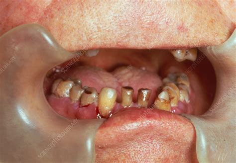 Scurvy Affecting Gums Of The Human Mouth Stock Image M2600035