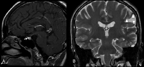 The Pituitary Microadenoma Arrow Is Shown In A Sagittal T1 Weighted
