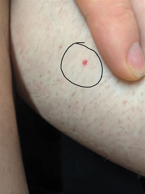 Skin Concerns I Am Finding Small Red Bumps That Look Like Surfaced