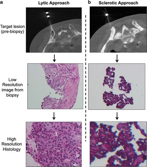 Successful Whole Exome Sequencing From A Prostate Cancer Bone