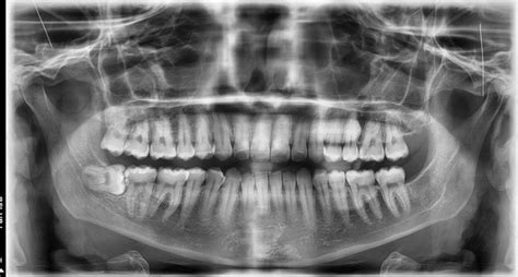 What Are The Black Lines On My Teeth Molars Rdentalhygiene