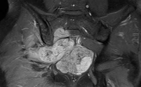 A 38 Year Old Male With Sacral Chordoma Presenting Transarticular