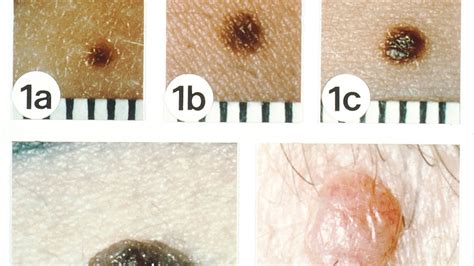 Non Melanoma Skin Cancers Skin Cancer Youtube
