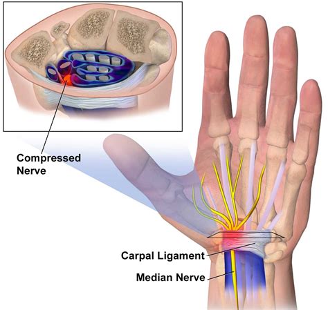 Carpal Tunnel Syndrome Diagnosis And Therapy Dr Scott Naftulin