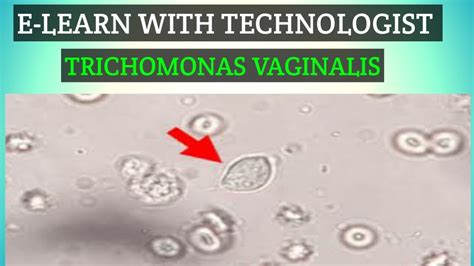 Trichomonas Vaginalis In Urine Under Microscope Youtube