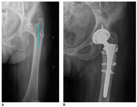 Total Hip Arthroplasty In Patients With Proximal Femoral Deformity