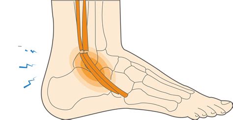 What Is A Peroneal Tendon Tear How To Treat Foot Injuries Upswing Health