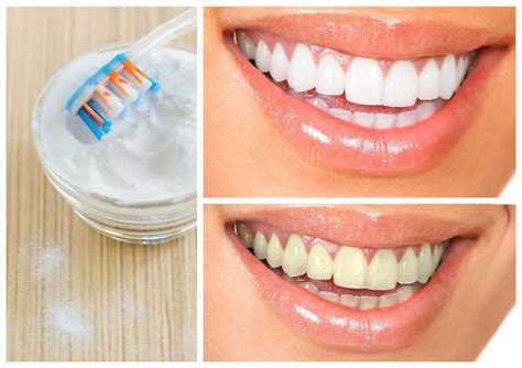 How To Whiten Teeth Naturally In Minutes At Home