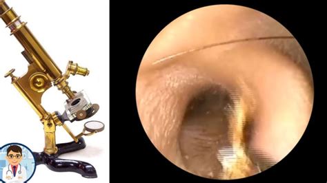Ear Wax Removal Very Satisfying 2020 Youtube
