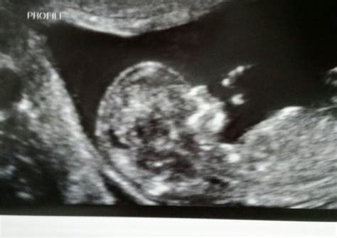 2 when a scan shows a nuchal translucency (nt) measurement of 3.5millimetres or more information for parents. nt measurement of 2.5mm, normal or not? - BabyCenter