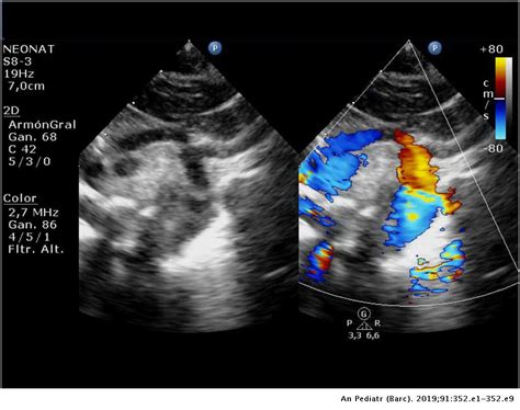 Current Surgical Options And Outcomes For Newborns With Hypoplastic