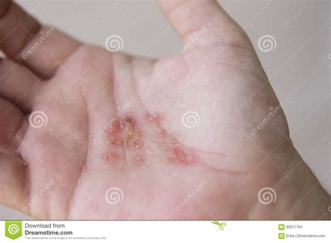 Dermatitis In Hands Stock Photo Image Of Atopic Eczema 93017754