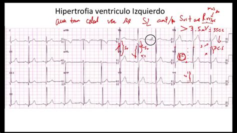 Criterio Sokolow Lyon Hipertrofia Ventriculo Izquierdo Ekg Youtube