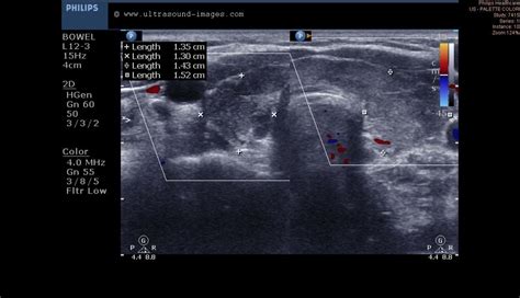 Ultrasound Imaging Thyroid Goiter 2d And 3d Images