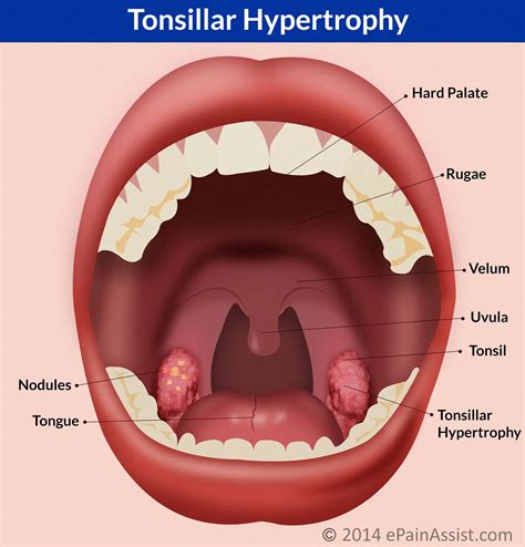 Tonsillar Hypertrophycausessymptomstreatment Antibiotics