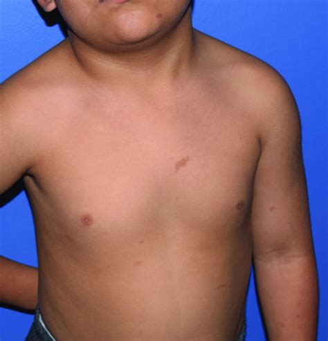 A 4 Year Old Presented To Our Pediatric Dermatology Clinic For